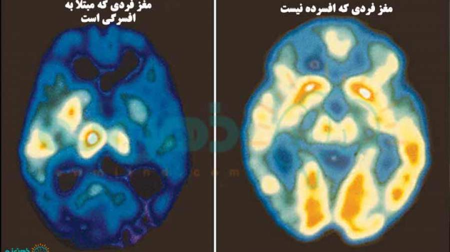 مغز فرد افسرده، یک میدان جنگ واقعی است!