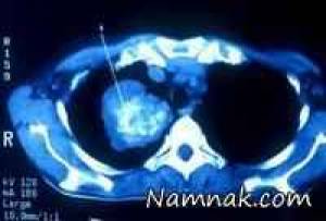 ساده ترین روش های پیشگیری از بیماری سرطان ریه
