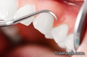 روش های پیشگیری از خونریزی و مشکلات لثه