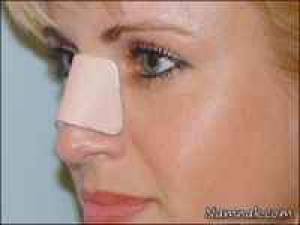 نکات مهم جراحی زیبایی بینی