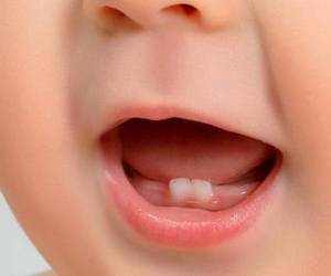 همه چیز دباره پوسیدگی دندان شیرخواران ، از علل تا راه حل