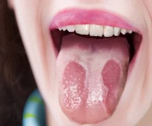همه چیز درباره بیماری زبان جغرافیایی ، از علل و علائم تا تشخیص و درمان