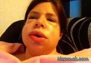 استرس صورت این زن را مثل توپ پر باد میکند