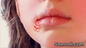 از زرد زخم، بیماری واگیردار پوستی چه میدانید