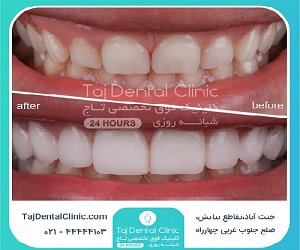 تفاوت لمینت و کامپوزیت ونیر دندان
