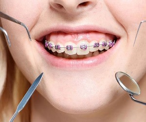 قبل از شروع ارتودنسی