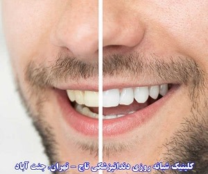 اصلاح طرح لبخند چه فرآیندی است
