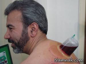 روز حزیران بهترین روز سال برای حجامت کردن