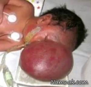 تولد نوزادی که مغزش روی صورتش رشد کرده بود