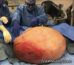 تومور شکم برداشته شد و زن 160 کیلویی 90 کیلو لاغر شد