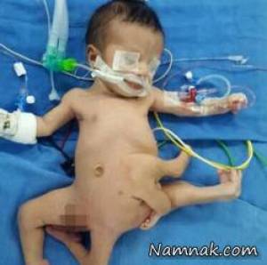 جراحی نوزادی با 8 دست و پا زیر تیغ جراحی رفت