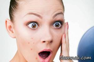 دلیل ایجاد جوش و آکنه روی پوست