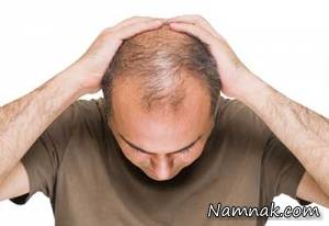 جلوگیری از کچل شدن ارثی