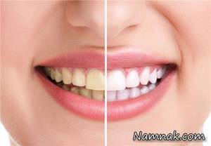 روش های سفید کردن دندان ها