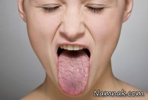 عوارض خطرناکی که در خشکی دهان نهفته است