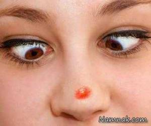 رابطه آرایش با جوش صورت