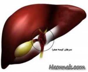 چگونگی تشخیص سرطان کیسه صفرا
