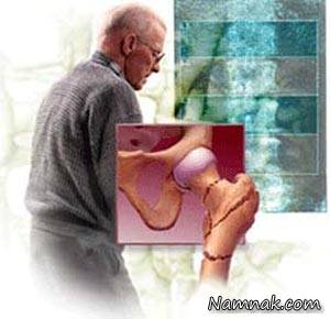 پوکی استخوان بیشتر از آن که علایم داشته باشد ، عوارض دارد