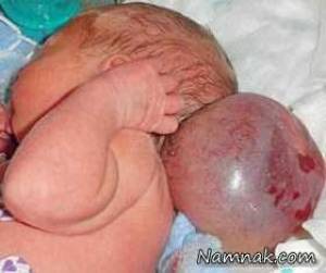 ضایعه جمجمه خطرناک بر روی سر نوزاد