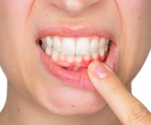 ژنژیویت لثه یا التهاب لثه چیست؟