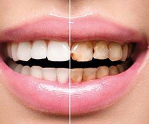 پوسیدگی دندان چیست؟