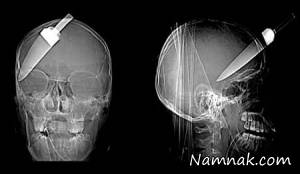 عکس های رادیولوژی هولناک
