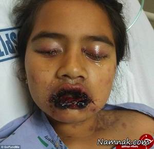 بیماری عجیب پوستی دختر 9 ساله نیوزلندی