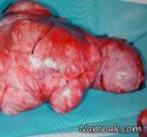 علائم تومور سرطانی در شکم زن با رشد جنین در دوران بارداری اشتباه گرفته شده بود