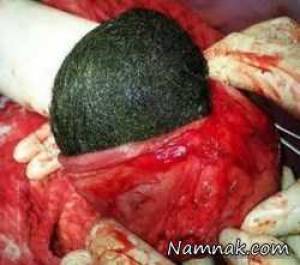 سندروم راپونزل و&nbsp;گلوله مویی به اندازه یک نارگیل از شکم زن جوان خارج شد: