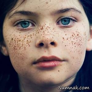 رهایی از شر کک و مک با ماسک جعفری
