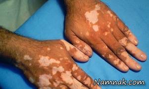 لک و پیس چگونه بوجود می آید؟