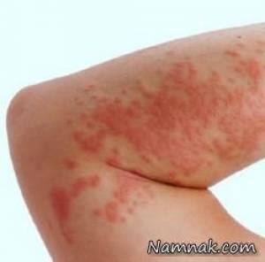 کهیر و راه های مقابله با آن