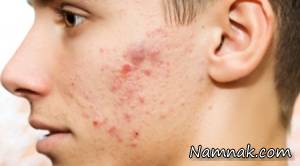 چه بخوریم که جوش نزنیم