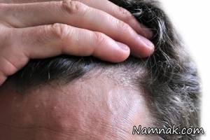 تغییر ظاهر موها خبر از کدام بیماری ها می دهد