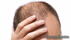 علت ریزش و سفید شدن زودهنگام موها