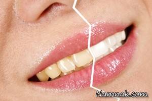 بروساژ و بلیچینگ دندان عارضه ای ندارند