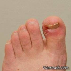 درمان رشد ناخن در گوشت پا با روش های خانگی&nbsp;Remedies to Treat Ingrown Nails