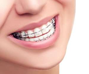 چه تفاوتی بین ارتودنسی ها وجود دارد، و کدام نوع برای شما مناسب است؟