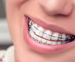 هر آنچه نیاز دارید تا در مورد ارتودنسی و روش انجام آن بدانید