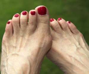 هالوکس والگوس بونیون شست پا و درمان آن