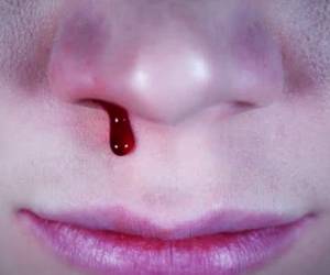 جلوگیری از خونریزی بینی با روشی صحیح