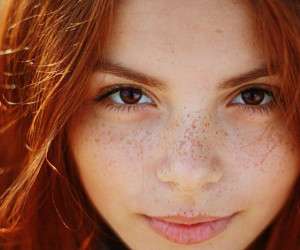 لکه های پوستی و علت آنها ، هر رنگ لکه های پوستی به چه دلیل روی پوست ما ظاهر می شود؟