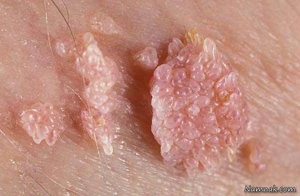 ویروس اچ پی وی (HPV) 