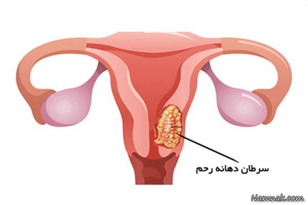 HPV اچ پی وی