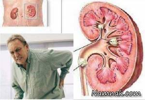 آیا درمان گیاهی سنگ کلیه صحت دارد