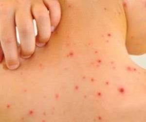 بیماری مورژلونز چیست و چه علائمی دارد؟