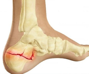 انواع شکستگی و کمک های اولیه لازم آن