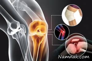 شایعات رایج درباره آرتروز
