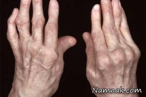 غذاهای ممنوعه در مبتلایان به آرتریت روماتوئید