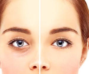 عمل بینی ارزان و هزینه جراحی بینی